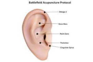 Battlefield Acupuncture
